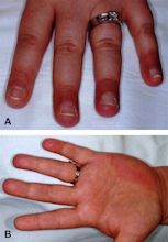 Red fingers syndrome in a patient with pseudolymphoma - Journal of the ...