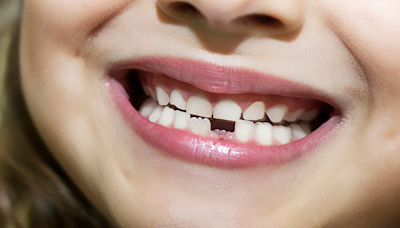 【高佑寧醫師專欄】兒童牙齒矯正的最佳時機是幾歲？專家帶妳了解早期矯正的重要性