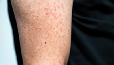 This year's measles case total is now the highest in the U.S. since 2019