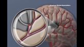 Position of stroke patient s head before surgery may improve neurological function