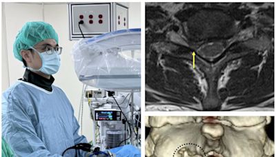 肩頸手臂痠痛麻 新竹臺大分院用頸椎內視鏡切除術 - 自由健康網
