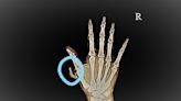 ¿Es normal tener seis dedos en una mano o pie?