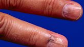 A woman had a line on her nail that looked like a splinter. She got it checked out and was diagnosed with an aggressive skin cancer.