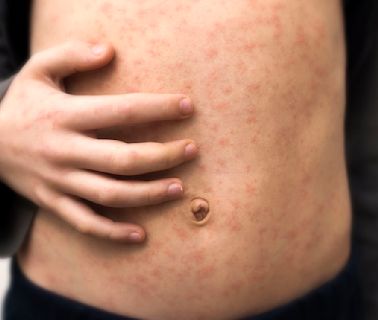 Measles cases have been reported in 19 states this year. What does a measles rash look like?