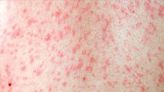 UK set to lose measles elimination status after surge in cases