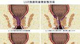 痔瘡卻又需服抗凝血藥 手術解圍不再滿褲子血