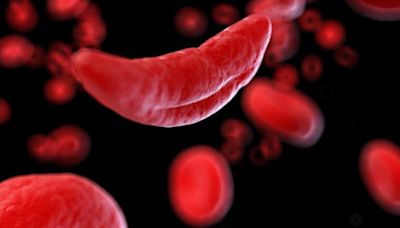 Researchers publish final results of key clinical trial for gene therapy for sickle cell disease