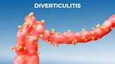 CRC Risk Appears Low in Most Patients With Diverticulitis