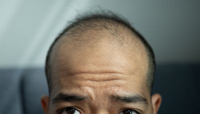 Doctor debunks five most common hair loss myths