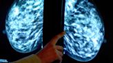 Health watchdog backs wider use of breast cancer tumour profiling tests