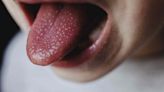 What Causes Strawberry Tongue?