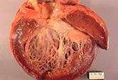 Cardiomyopathy