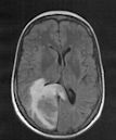 cerebral oedema