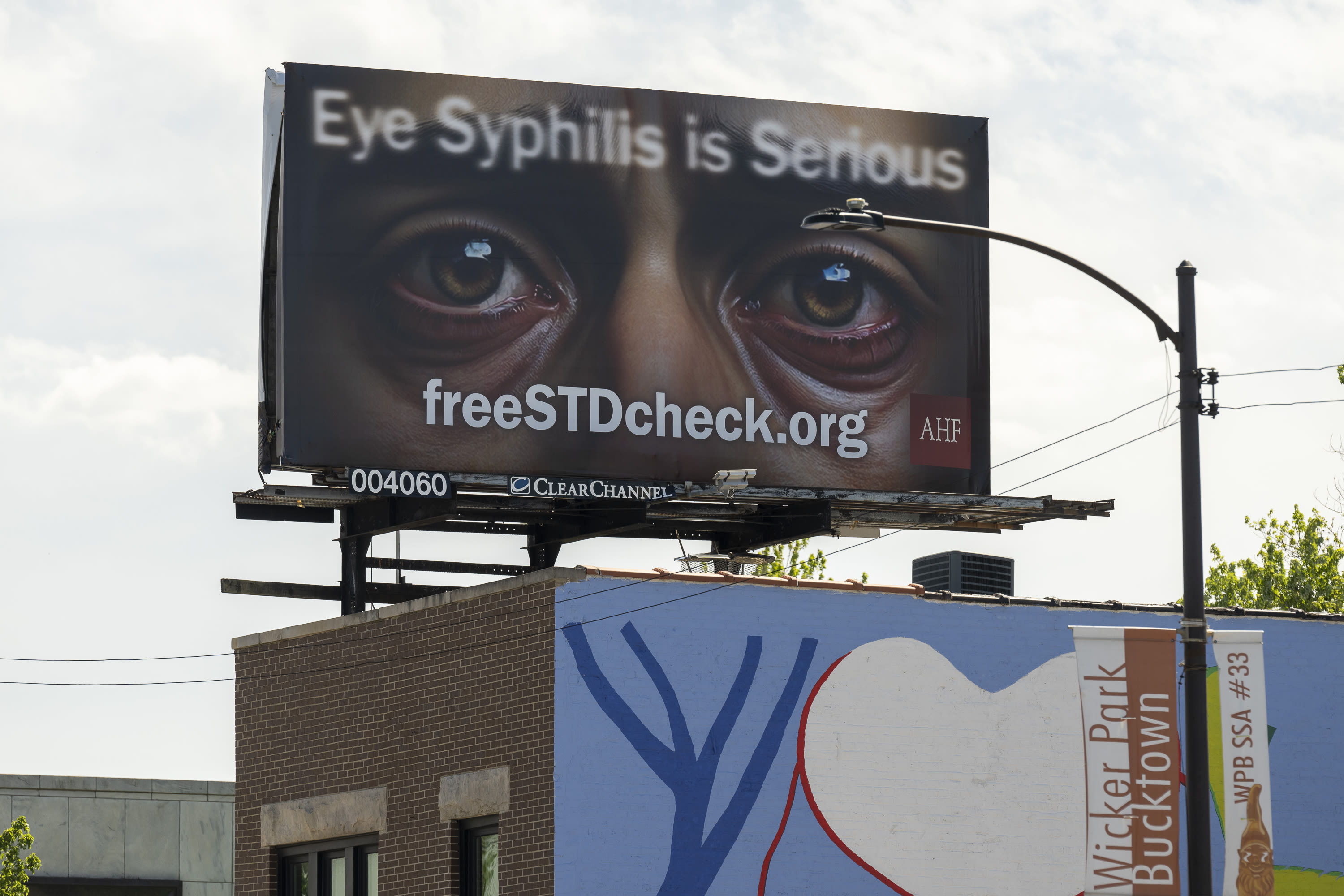 Rare and acute syphilis symptoms increasingly appearing in Chicago patients, study says
