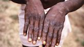 New deadly mpox variant 'very likely' already in UK, expert warns