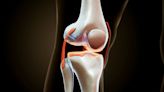 AI-powered test predicts knee osteoarthritis 8 years before X-ray