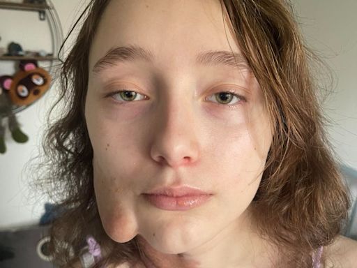 Girl with facial tumours forced to wait for vital operation due to doctors’ strikes and NHS bed shortage
