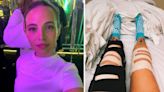 'I crashed into a bus on my e-scooter': Woman learns to walk again after freak accident