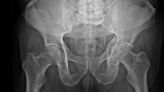 La Nación / La osteoporosis aumenta el riesgo de sufrir fracturas