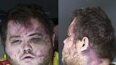 Mugshot shows Colorado Springs suspect Anderson Aldrich with face and neck wounds