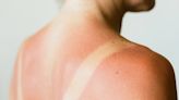 Do you have heat rash or sun poisoning? Look for these important differences, derms say