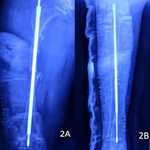 Osteogenesis imperfecta