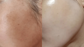 I had severe hyperpigmentation - a trick I tried on a whim transformed my face