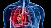 Lung Cancer spreads to brain silently, causes major concern