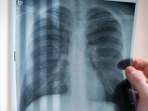 慢跑男「狂咳2月」癌末亡 醫示警：有害物質全進肺