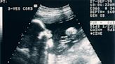 Q&A – Florida’s Amendment 4, What’s the Definition of Fetal Viability? | 1290 WJNO