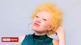 'Meu estuprador acreditava que atacar uma pessoa albina o protegeria de doenças'