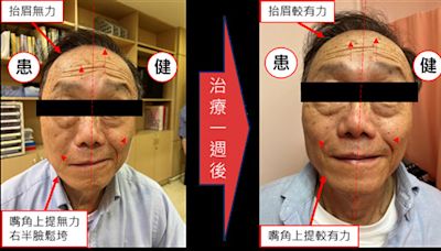 71歲男一早刷牙竟「顏面神經麻痺」 靠中醫針灸改善情況