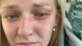 Gabby Petito’s injuries in Utah domestic dispute call with Brian Laundrie revealed in new photo