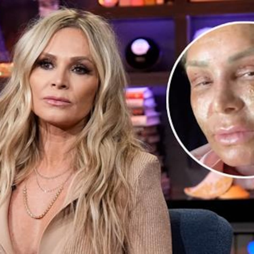 Tamra Judge Shares Her Mom's Reaction to Her Face After Cosmetic Procedure - E! Online