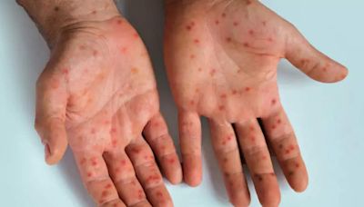 Australia sees surge in mpox cases - ET HealthWorld