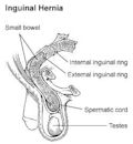 Hernia