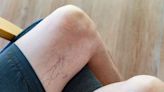 How Varicose Veins Are Treated