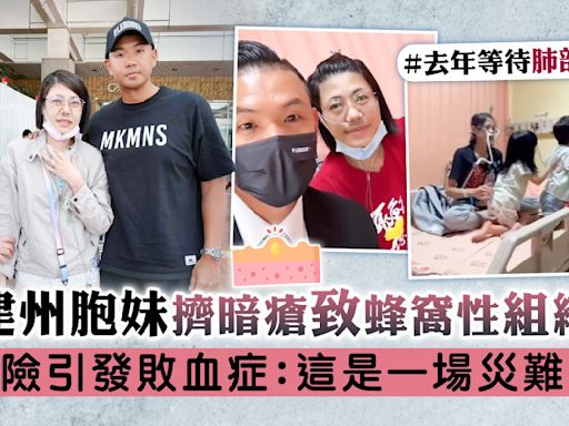 陳建州胞妹擠暗瘡致蜂窩性組織炎 險引發敗血症：這是一場災難