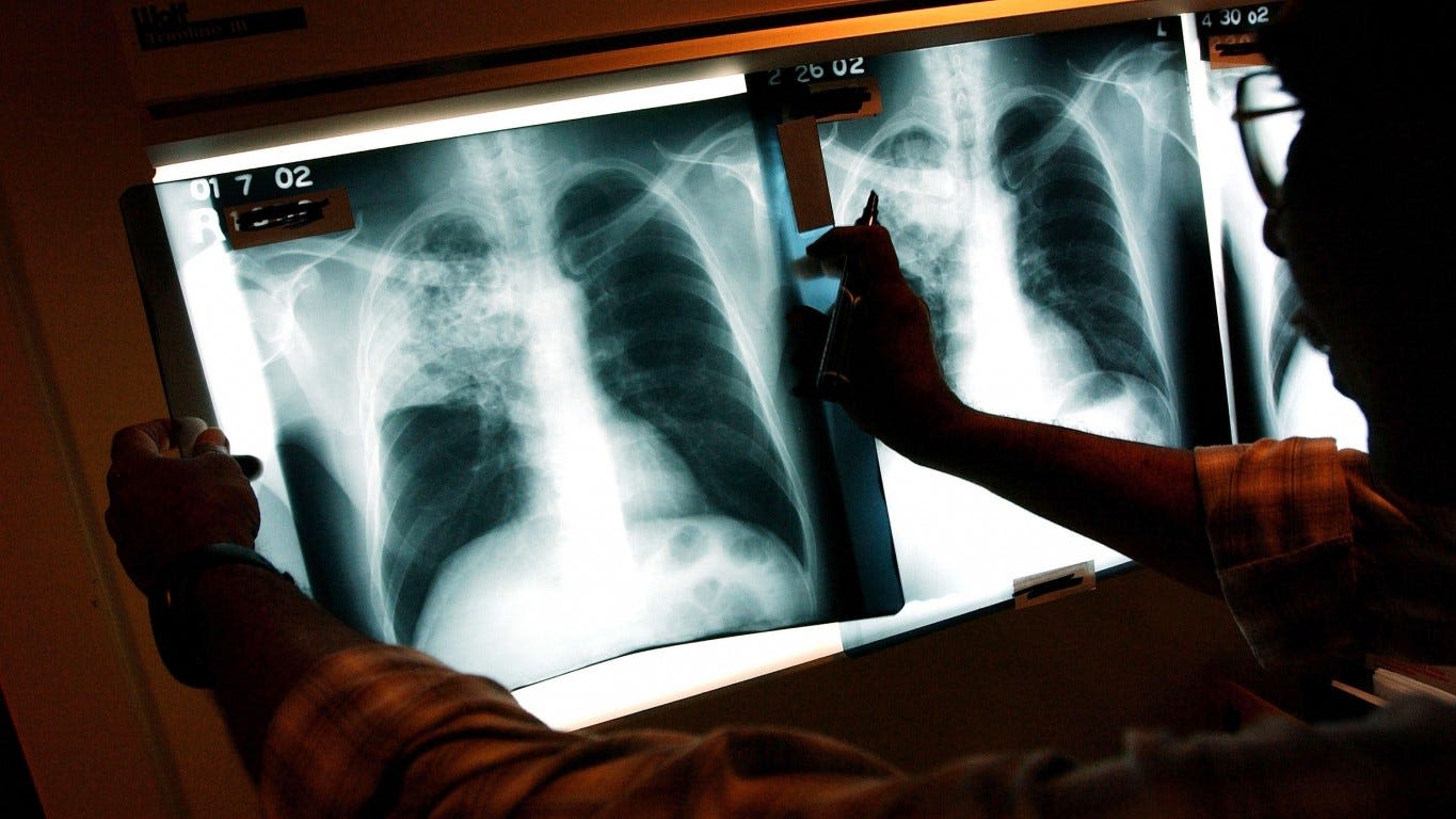 Tuberculosis in California: Outbreak declared in Long Beach, 1 dead, 9 hospitalized