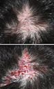 Hair transplantation