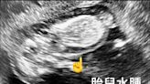 懷孕11週發現「胎兒水腫」孕婦崩潰 醫：四分之一會胎死腹中