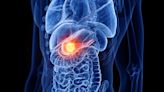 Can Chemo Benefit Older Patients With Pancreatic Cancer?