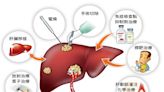 術後第一年復發率約 20 % ！ 肝癌治療後， 減少復發率可以怎麼做？
