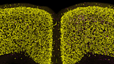 Scientists identify cell vulnerability ‘fingerprint’ related to Parkinson’s, Lewy body dementia