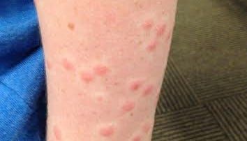 Swimmer's itch rash from Michigan bodies of water: Treatment, prevention information
