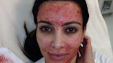 Women Diagnosed With HIV After “Vampire Facial” Procedures Popularized by Kim Kardashian