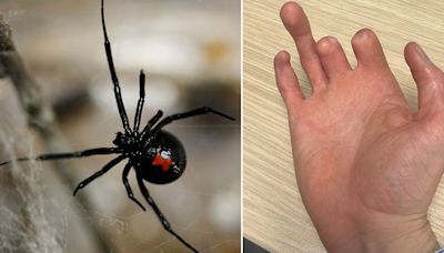 Man has fingers amputated after shocking spider bite on holiday in Ibiza