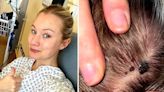 A 29-year-old woman found a mark on her head and was diagnosed with a fungal infection. It turned out to be invasive skin cancer.