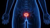 The Biggest Risk Factor for Bladder Cancer Has Nothing to Do With Pee, Diet, or Genes