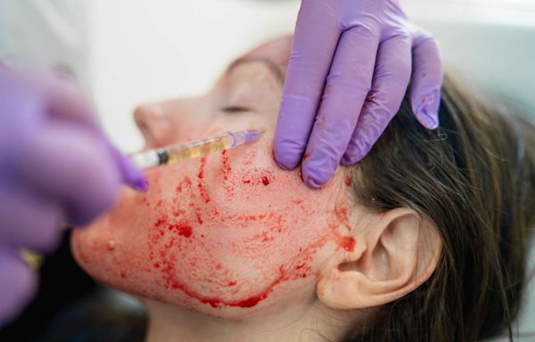 What Is a 'Vampire Facial'? Experts Discuss the Cosmetic Procedure and Risk of HIV Infection
